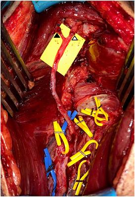 Defining the Reliability of Deltoid Reanimation by Nerve Transfer When Using Abnormal but Variably Recovered Triceps Donor Nerves